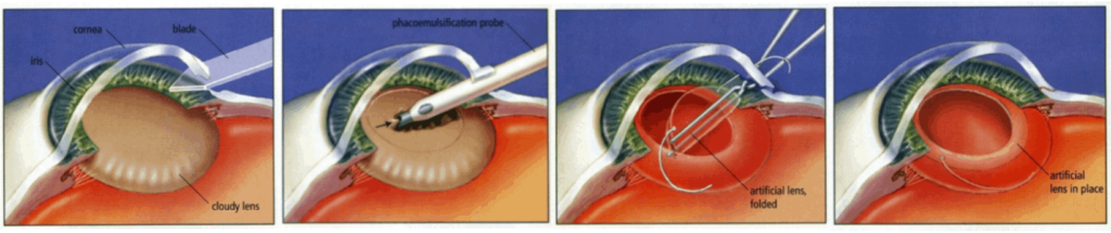 Advanced Cataract Surgery in Dhule