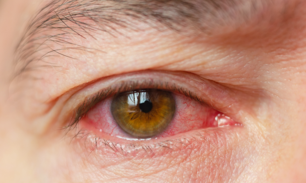 Corneal Infection Treatment in Dhule