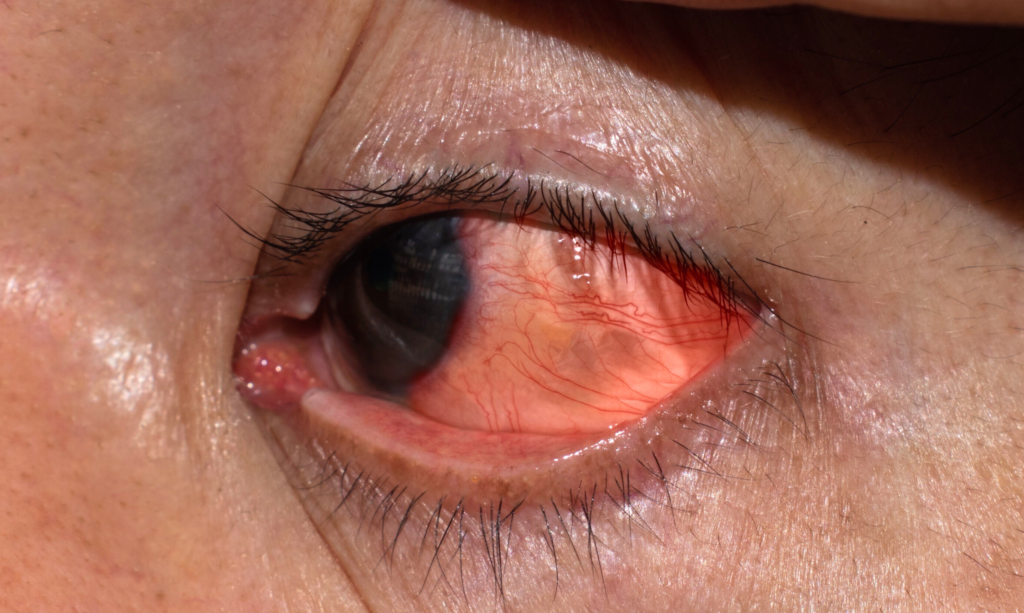 Corneal Infection Treatment in Dhule