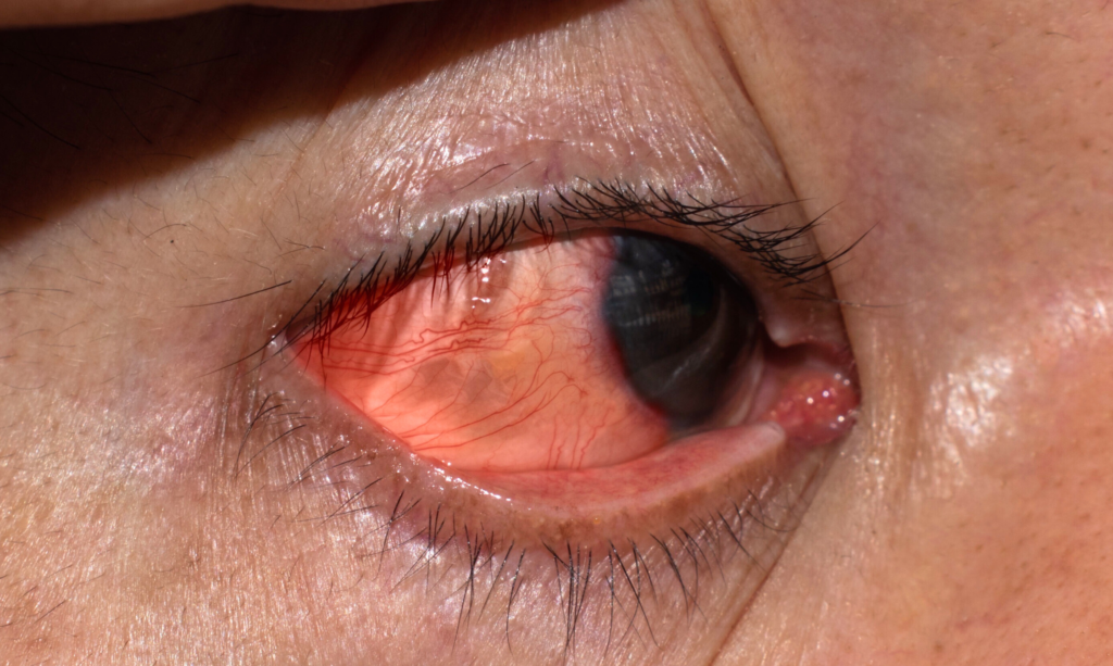 Corneal Infection Surgery in Dhule